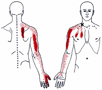 [Scalenus trigger point, Travell & Simons Vol. 1 Figure 20.1A]