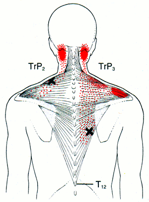 [Trapezius triggerpoints, Travell & Simons Vol. 1 Figure 6.2]