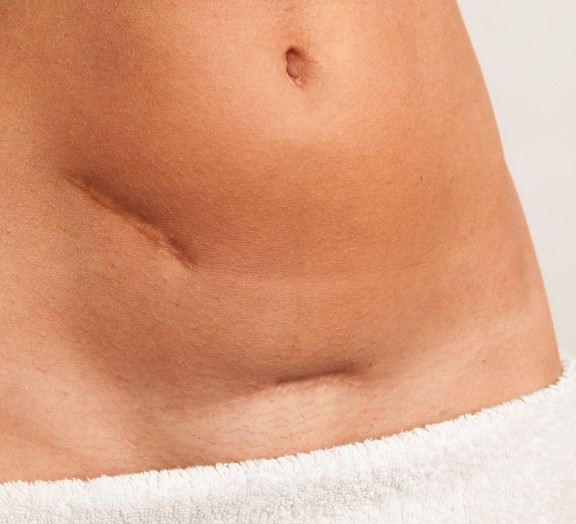 [Scars in lower abdomen]